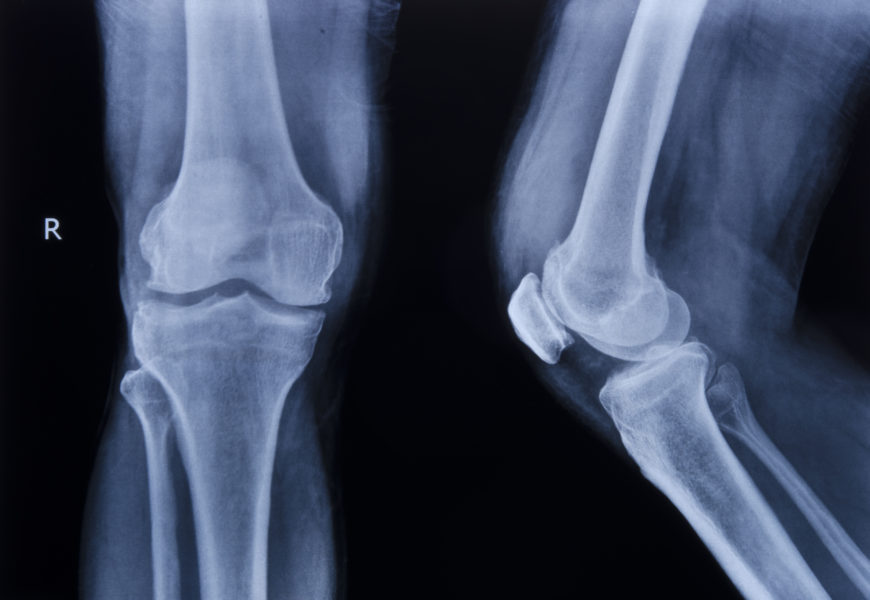 Knee Radiology Made Surprisingly Simple Digital Teaching